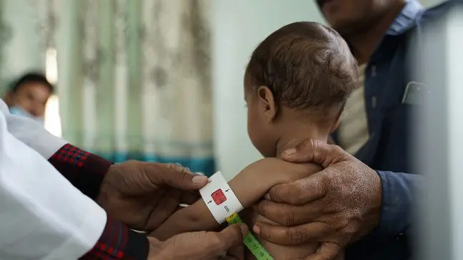 yemen-child-malnutrition